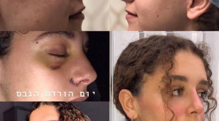 תמונות ניתוח אף