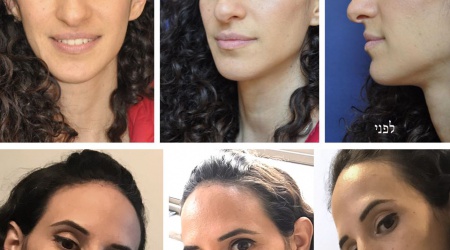 ניתוח אף לפני ואחרי