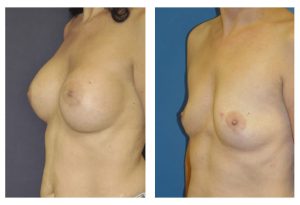 תמונה להמחשה, לפני ואחרי ניתוח הגדלת שדיים 